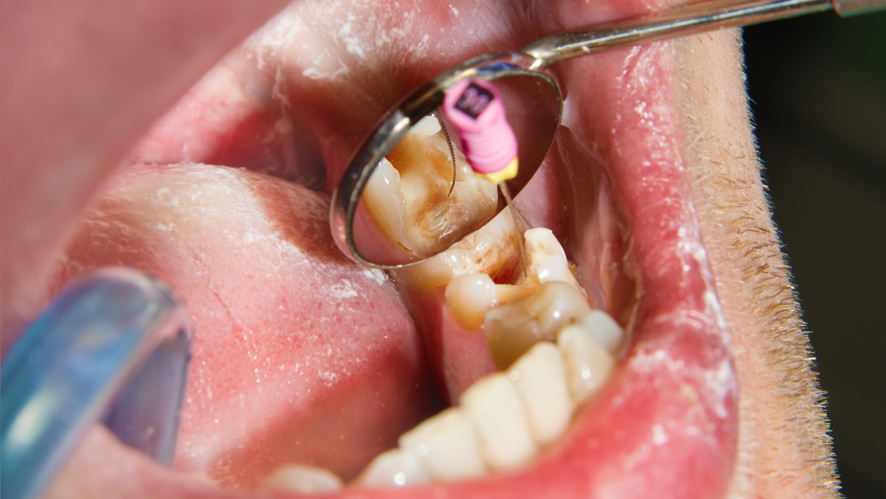 ząb do leczenia kanałowego
