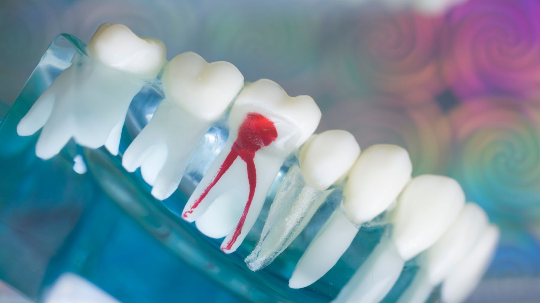 ból zęba po leczeniu kanałowym