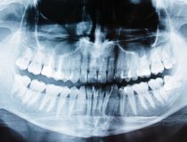 rtg zęba ciemna plama