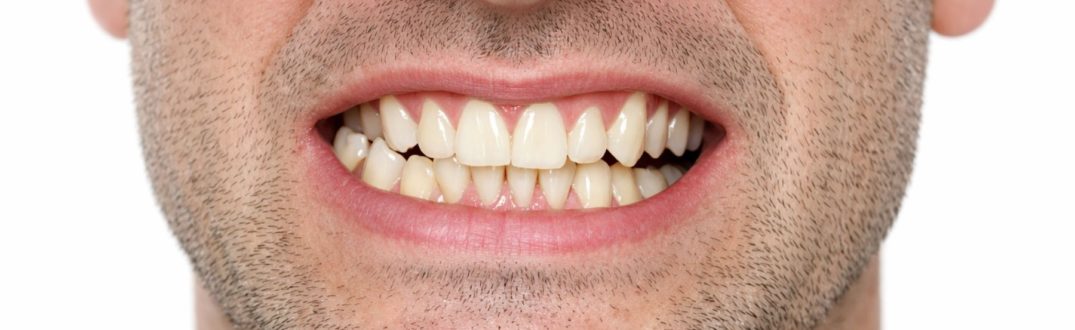 Zgryz krzyżowy u dorosłych